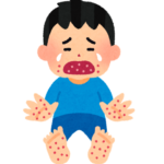 手足口病の初期症状ってどんなの？